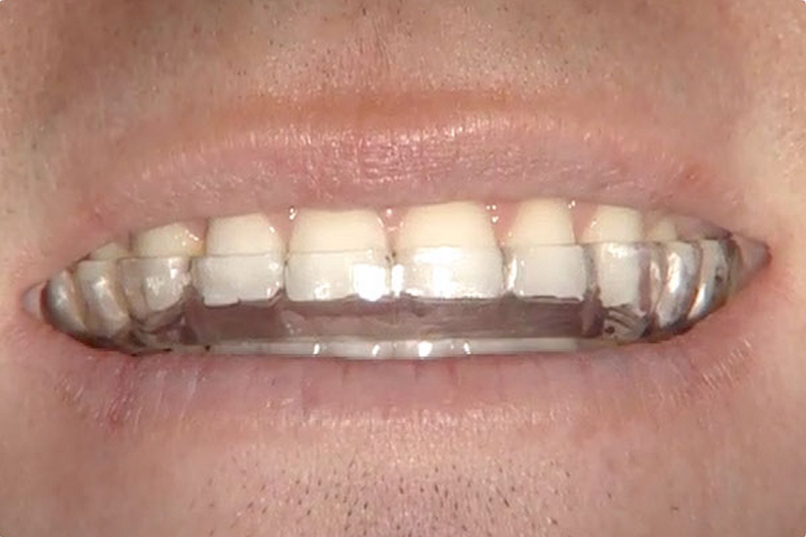 Wearing a night guard after crown dental application